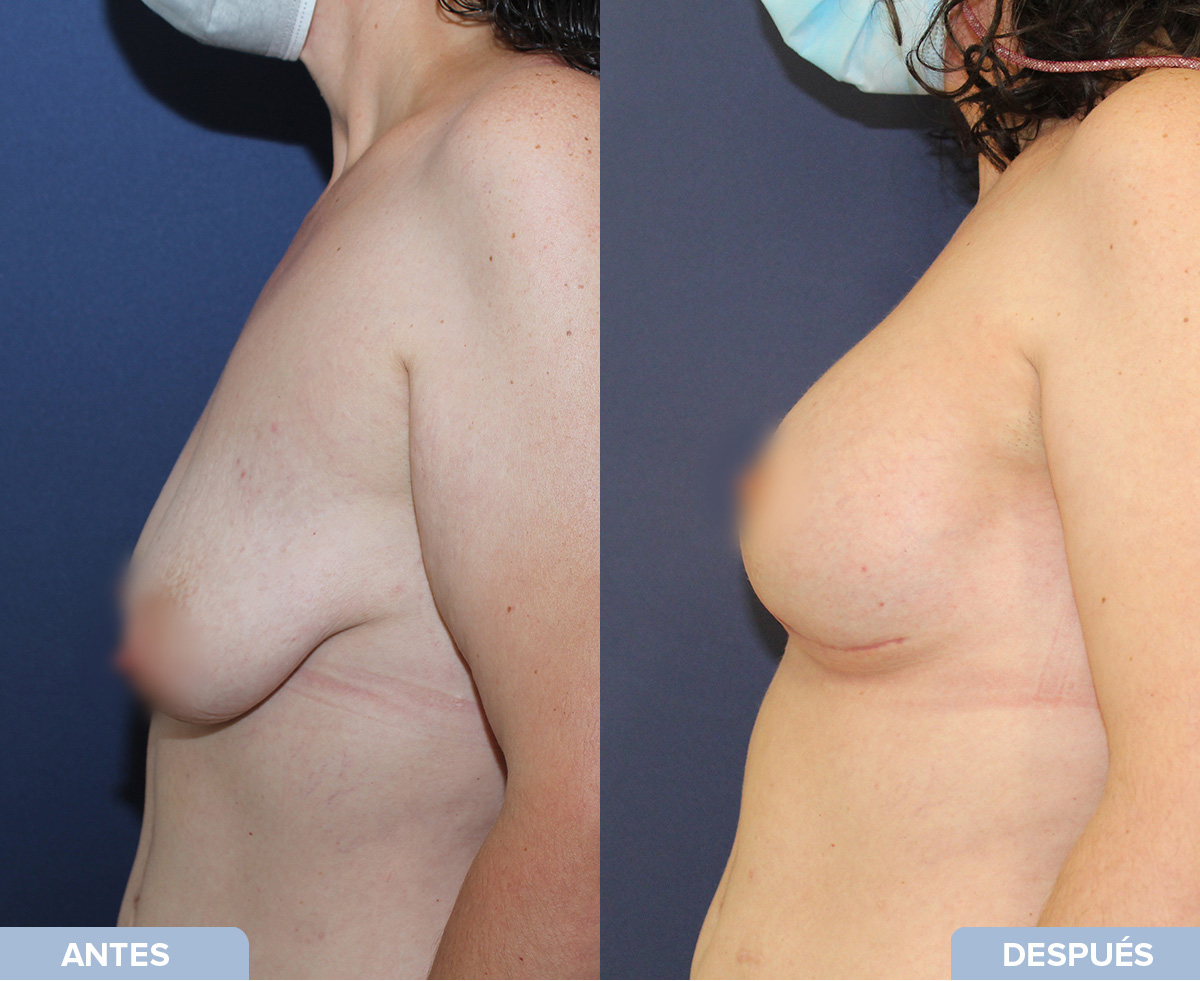 Paciente muestra el resultado del procedimiento, un antes y un después