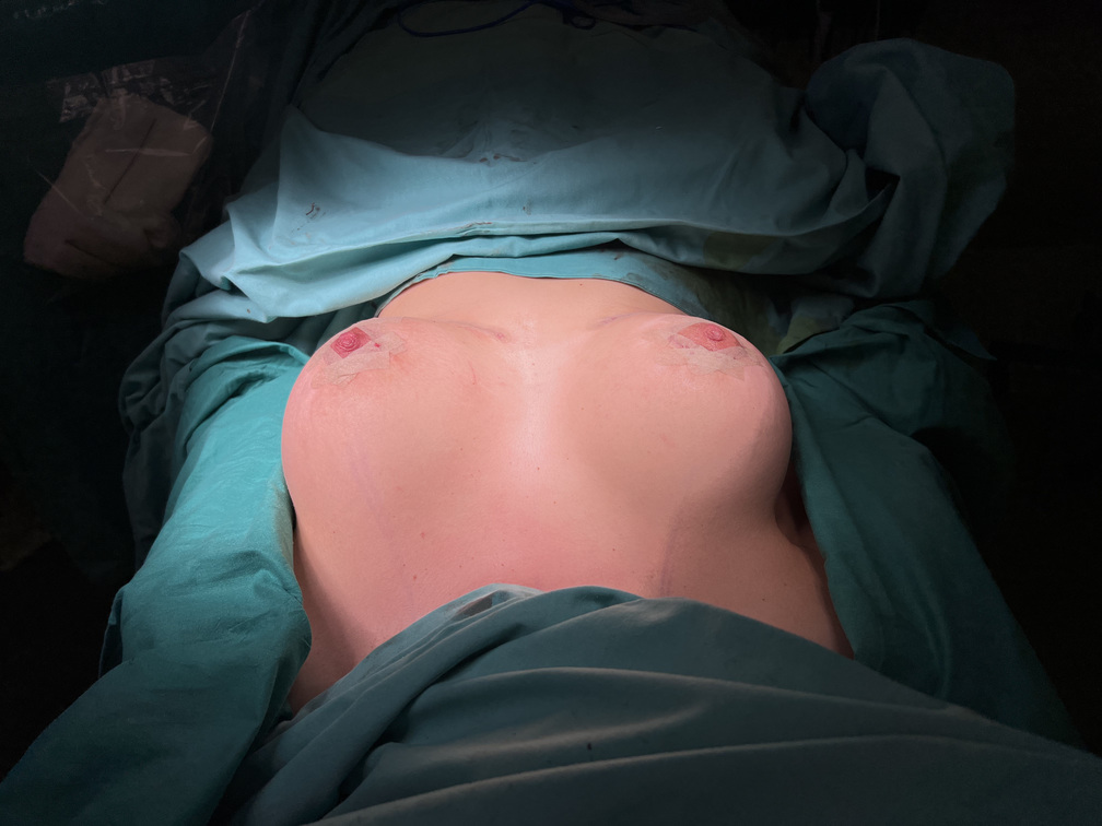 Paciente durante el procedimiento de mastopexia en la Clínica Pérez Espadero de Valencia