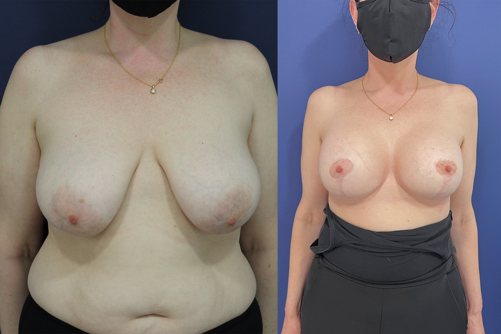 Resultado, un antes y un después, de una paciente después del procedimiento de mastopexia